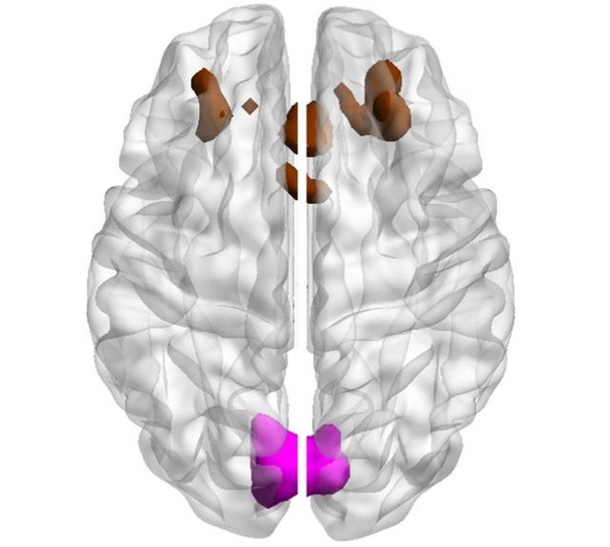 Ilustração de cérebro humano com duas áreas destacadas - Metrópoles